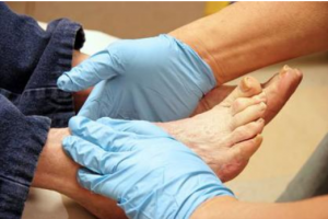Got Diabetes? Why You Must Protect Your Feet